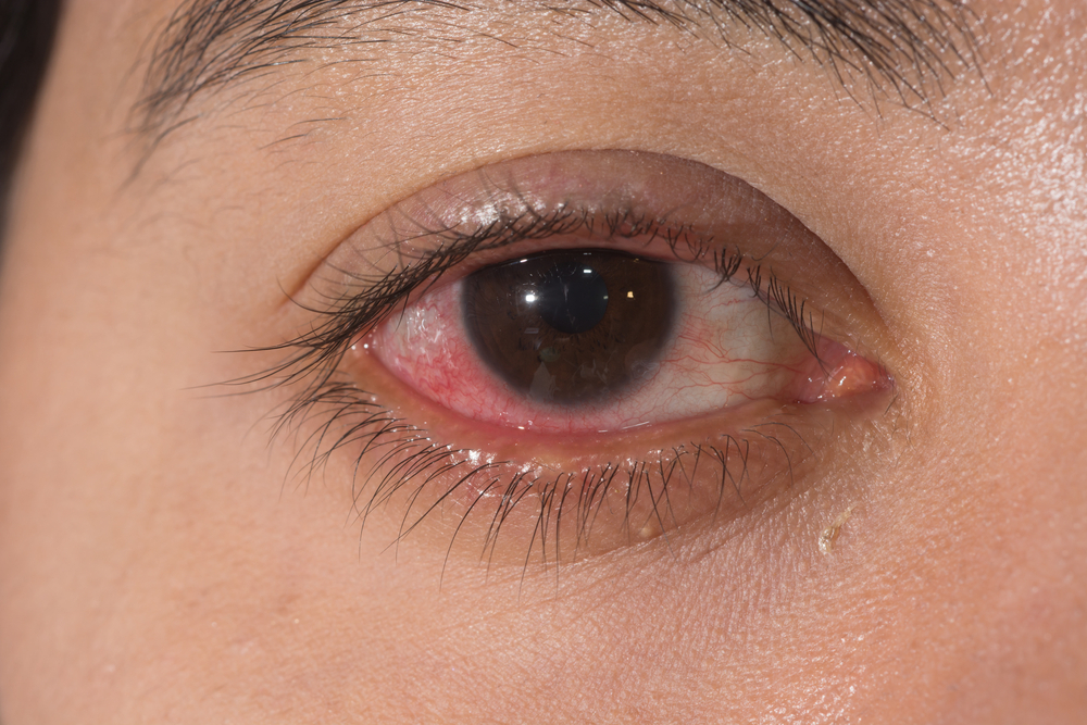 Triệu chứng viêm giác mạc: Đỏ mắt