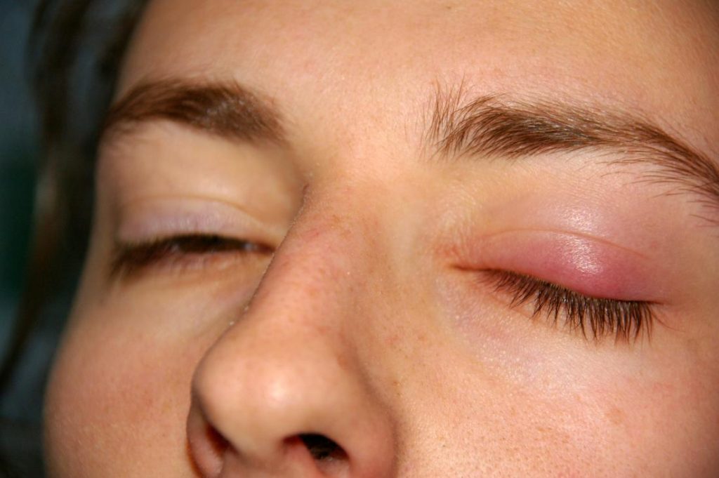 Sưng mắt là dấu hiệu sớm của các bệnh về mắt phổ biến
