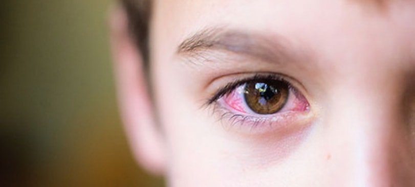 Đỏ mắt là triệu chứng viêm giác mạc