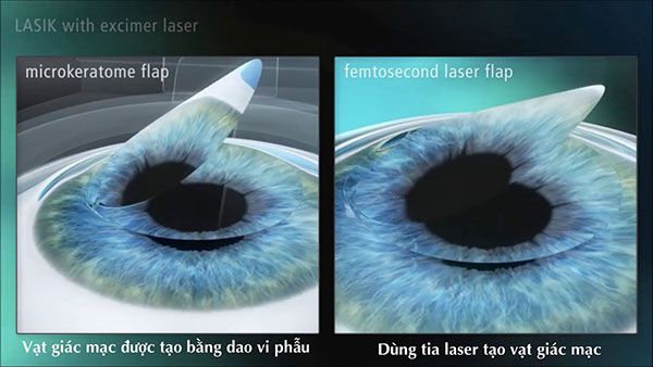 Phương pháp Laser trên giác mạc