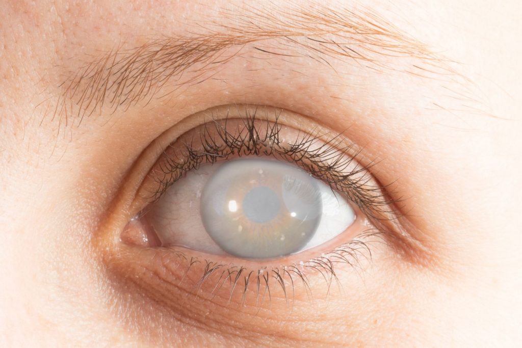 Các bệnh gây mù lòa có thể phòng tránh